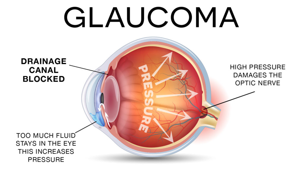 The Glaucoma Service