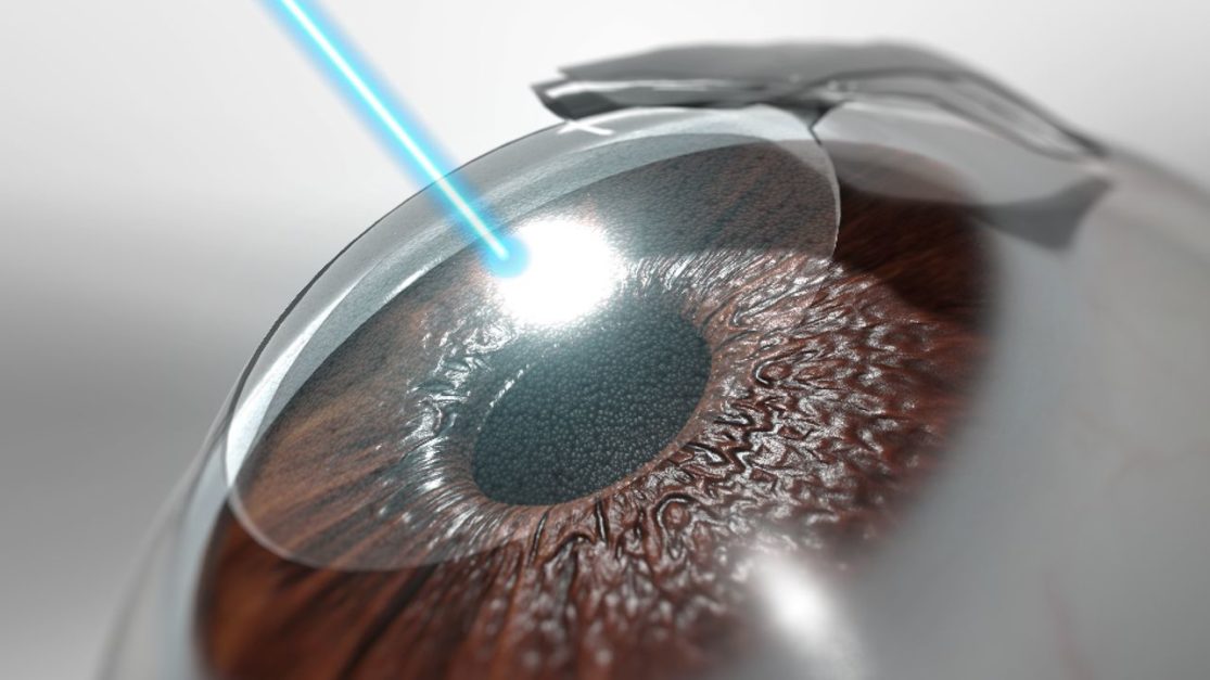 LASIK eye treatment 