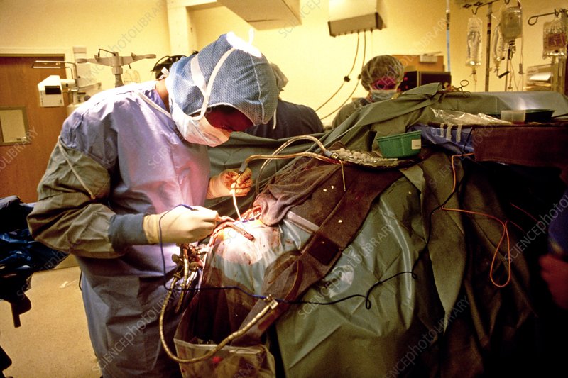 A neurosurgeon at work in an operating theatre. Conditions treated by neurosurgery include tumours of the brain and spinal cord, brain hemorrhage, types of epilepsy and some birth defects.