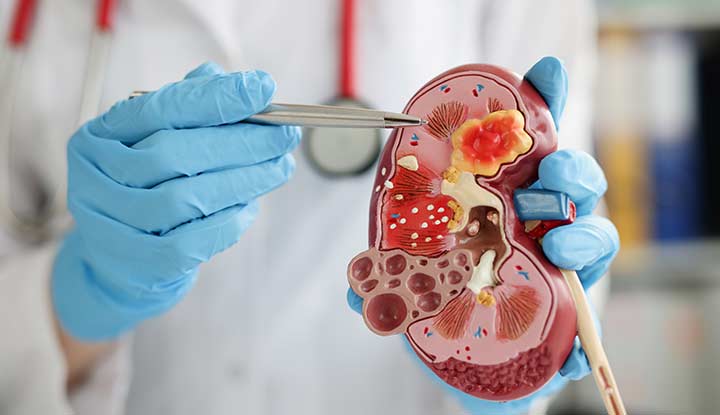 Nephrologist holding a dummy kidney'